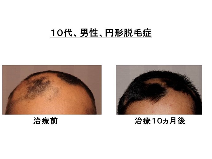 円形脱毛症　病院